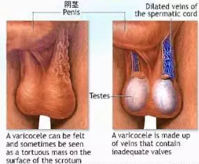 成都男性阴囊长“蚯蚓”小心不育 缘是精索静脉曲张
